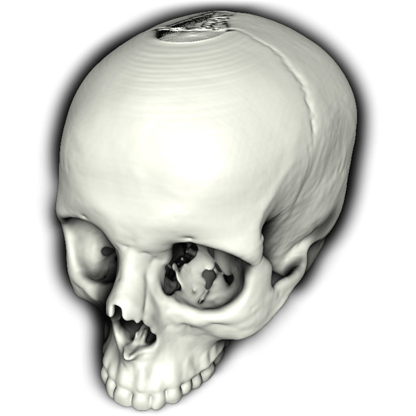 Human Skull: Volume rendering of a human skull using volumetric halos